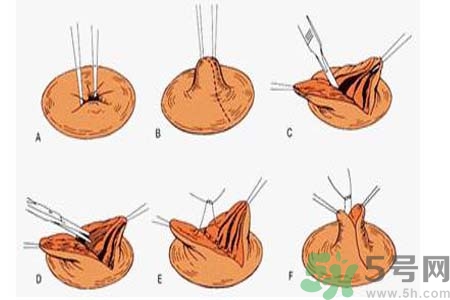 乳頭內(nèi)陷可以拔罐嗎？乳頭內(nèi)陷需要手術(shù)治療嗎？