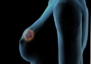哺乳期乳房有硬塊疼痛怎么辦？如何預(yù)防哺乳期乳房有硬塊？