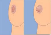 乳頭內(nèi)陷可以用吸奶器嗎？乳頭內(nèi)陷能不能用吸奶器？