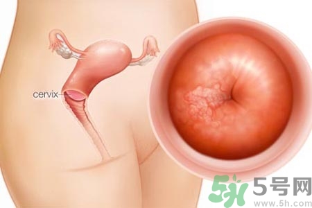 陰道松弛是什么？陰道松弛的癥狀有哪些？