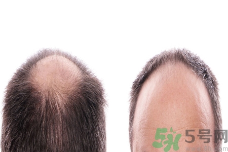 頭發(fā)稀少的原因是什么？如何預(yù)防禿頂?shù)陌l(fā)生？