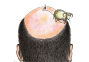 禿頂會(huì)遺傳嗎？治療禿頂?shù)姆椒ㄊ鞘裁矗?><p><strong>禿頂會(huì)遺傳嗎？治療禿頂?shù)姆椒ㄊ鞘裁矗?/strong></p></a></li> </ul>
</div>
<div   id=