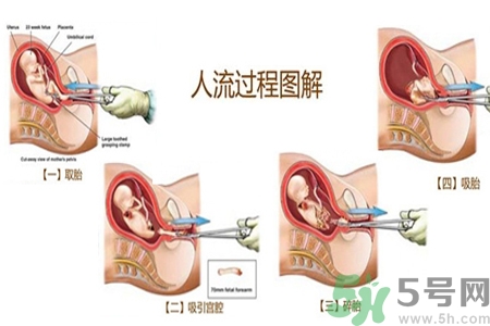 人工流產(chǎn)后多久可以再次懷孕？流產(chǎn)后需要注意什么？