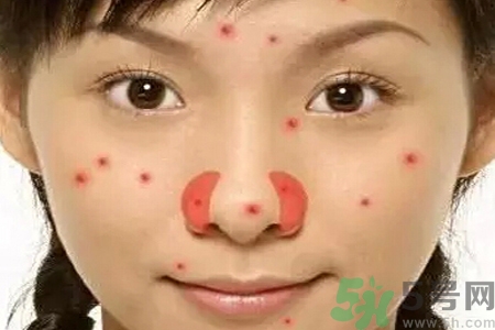 鼻翼長痘痘怎么回事？鼻翼長痘痘的原因是什么？