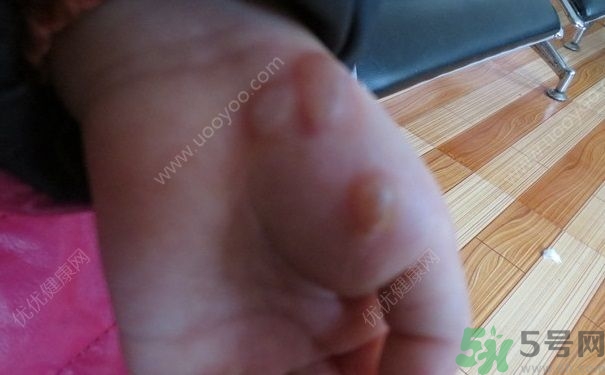 15歲還會(huì)得手足口病嗎？手足口病的癥狀有哪些？