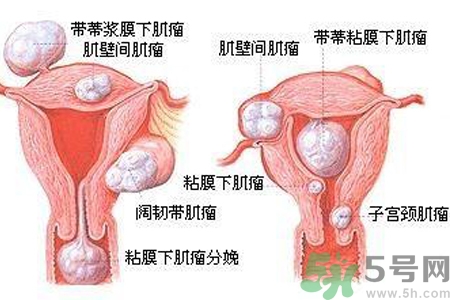 ?子宮移位怎么治療？子宮移位能懷孕嗎？