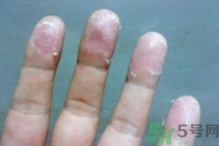 ?手掌脫皮的危害有哪些？如何預(yù)防手掌脫皮？