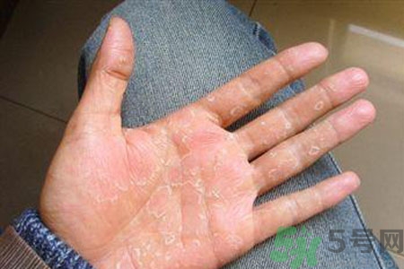 ?手掌脫皮的危害有哪些？如何預(yù)防手掌脫皮？