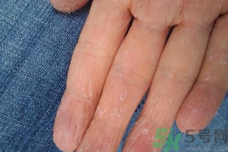 ?手掌脫皮的危害有哪些？如何預(yù)防手掌脫皮？