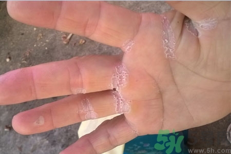 手脫皮是什么原因？手脫皮的治療方法是什么？