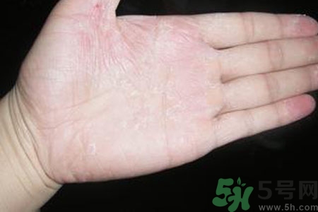 手脫皮是什么原因？手脫皮的治療方法是什么？