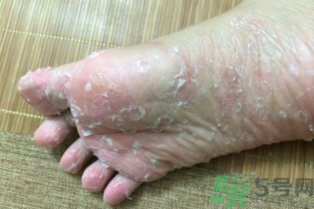 腳脫皮是怎么回事？腳脫皮怎么辦？