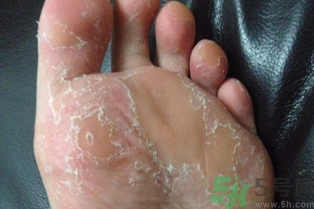 腳脫皮是怎么回事？腳脫皮怎么辦？