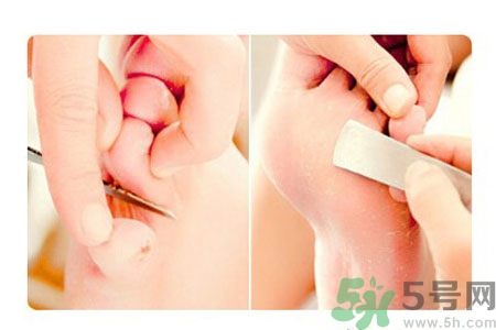 雞眼怎么能徹底根治？如何預(yù)防腳上長(zhǎng)雞眼？
