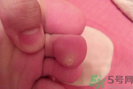 雞眼怎么能徹底根治？如何預(yù)防腳上長(zhǎng)雞眼？