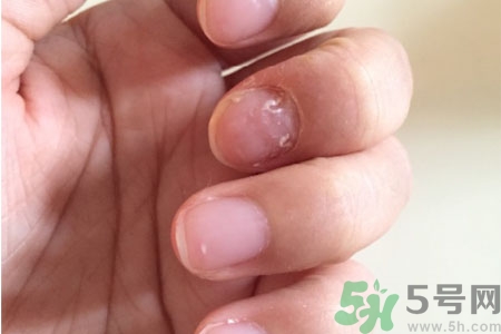 孩子手指甲凹凸不平是什么原因？手指甲凹凸不平的原因是什么？