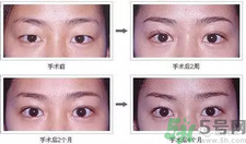 提眉術(shù)后多久可以恢復(fù)？提眉術(shù)后全過程照片