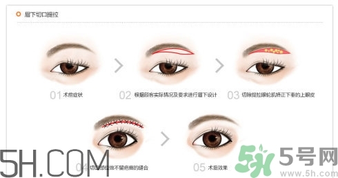 切眉手術(shù)后老得快嗎？切眉能保持多久？