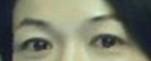 提眉術(shù)后多久可以恢復(fù)？提眉術(shù)后全過程照片