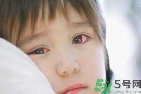 流行性腮腺炎的表現(xiàn)有哪些？?流行性腮腺炎飲食怎么調(diào)理？
