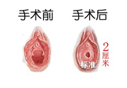處女膜修補術(shù)效果怎么樣？處女膜修復手術(shù)有風險嗎？