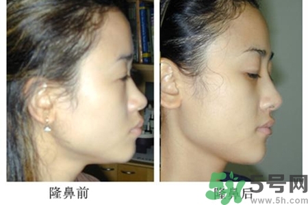 玻尿酸隆鼻的危害有哪些？玻尿酸隆鼻的副作用是什么？