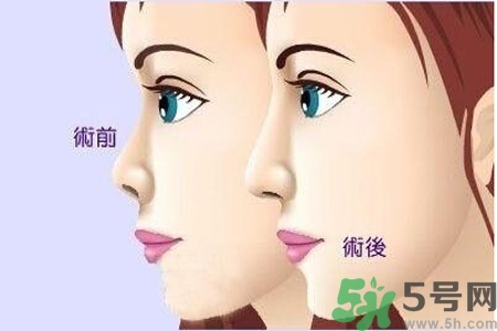 玻尿酸隆鼻的缺點(diǎn)是什么？玻尿酸隆鼻的優(yōu)點(diǎn)有哪些？