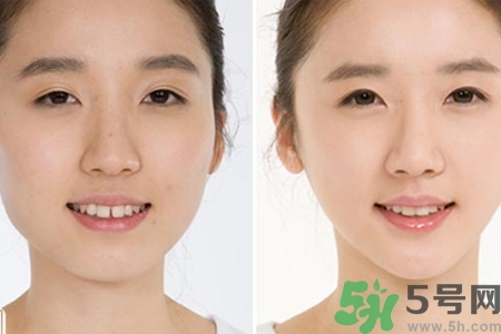 玻尿酸隆鼻的缺點(diǎn)是什么？玻尿酸隆鼻的優(yōu)點(diǎn)有哪些？