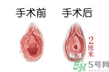 什么人不能做處女膜修補術(shù)？處女膜修補術(shù)會留疤嗎？