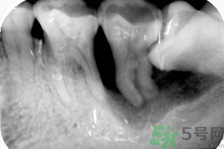 拔智齒一顆多少錢？拔除智齒收費(fèi)多少？