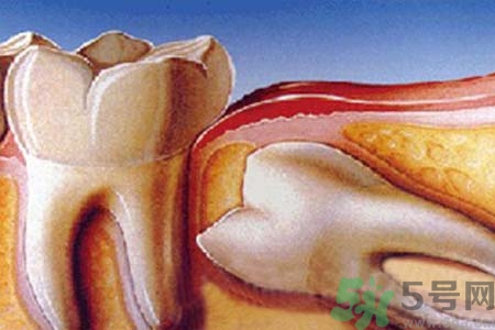 拔智齒一顆多少錢？拔除智齒收費(fèi)多少？
