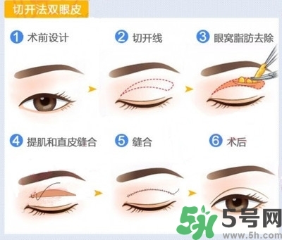 雙眼皮手術哪種最好？割雙眼皮后注意些什么？