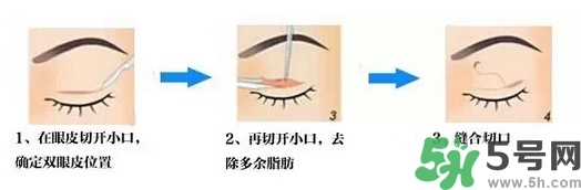 雙眼皮手術哪種最好？割雙眼皮后注意些什么？