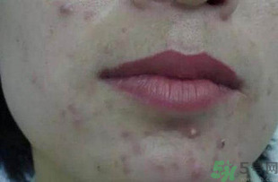 什么樣的痘痘能擠？哪些痘痘不能擠？