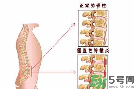 僵直性脊椎炎的癥狀有哪些？怎樣預(yù)防僵直性脊椎炎？
