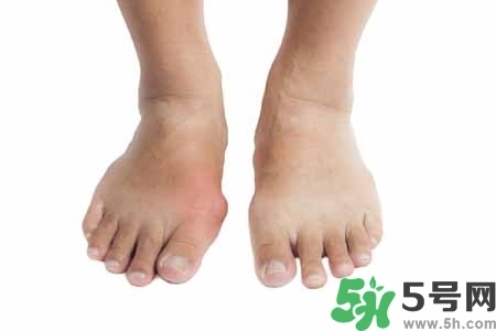 引發(fā)痛風(fēng)的原因是什么？痛風(fēng)病人飲食需注意什么好？