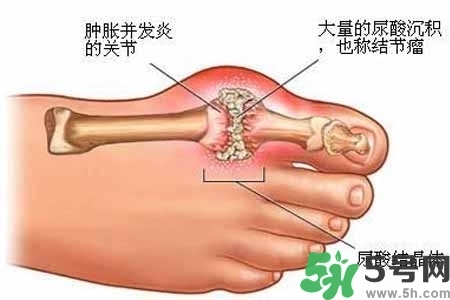 引發(fā)痛風(fēng)的原因是什么？痛風(fēng)病人飲食需注意什么好？