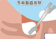 智齒拔完后有個洞怎么辦？拔智齒后有個洞多久能長好？