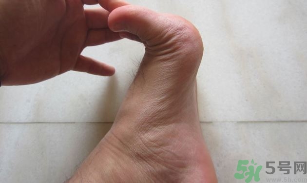 腳拇指外翻遺傳嗎？腳拇指外翻怎么矯正？