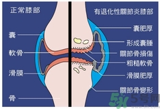 骨關(guān)節(jié)炎能治好嗎？骨關(guān)節(jié)炎平時(shí)注意事項(xiàng)