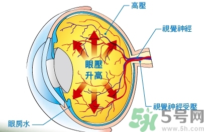 青光眼可以治愈嗎？青光眼怎樣治療？