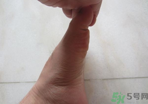 腳拇指外翻遺傳嗎？腳拇指外翻怎么矯正？