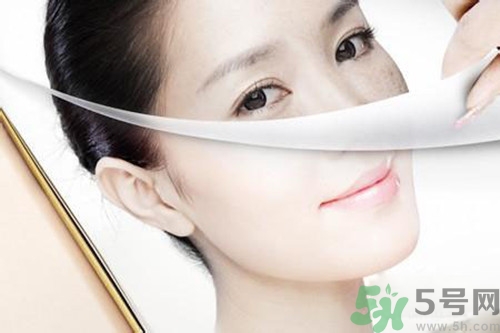 曬斑可以自己消退嗎？曬斑可以用激光去除嗎？