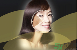 曬斑可以自己消退嗎？曬斑可以用激光去除嗎？