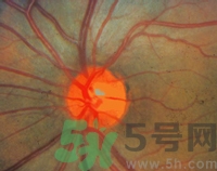 青光眼可以治愈嗎？青光眼怎樣治療？