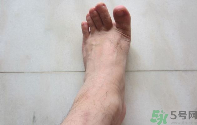 腳拇指外翻遺傳嗎？腳拇指外翻怎么矯正？