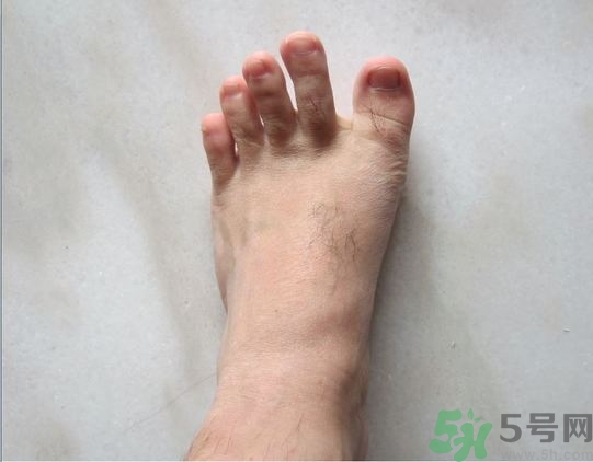 腳拇指外翻遺傳嗎？腳拇指外翻怎么矯正？