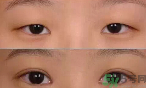 天生腫眼泡怎么消除？天生腫眼泡怎么辦？