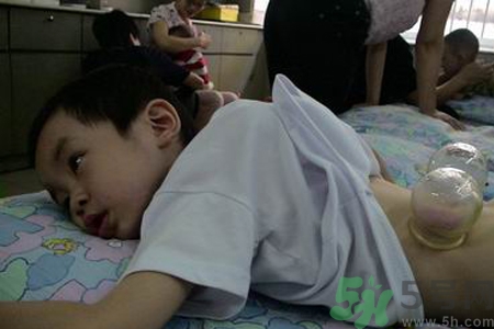 小孩可以拔罐嗎？寶寶能拔火罐嗎？