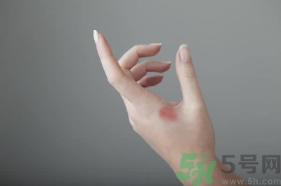 手被燙紅了怎么辦？手被燙了怎么止痛？